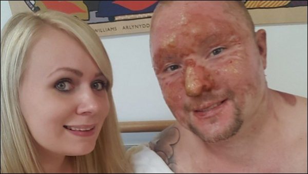 Ben Longville is being supported in his recovery by wife Sarah after suffering serious burns